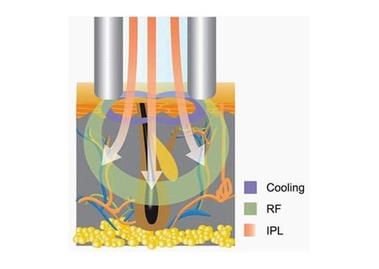 E-Light (IPL+RF)