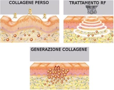 Principio di funzionamento della radiofrequenza multi-polare